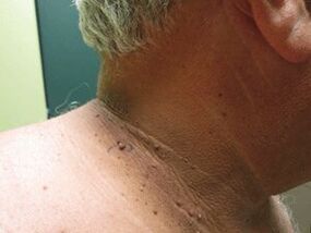 Причините за появата на множествени папиломи върху тялото