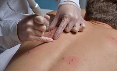 начини за премахване на папиломи