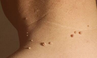 причини за папиломи