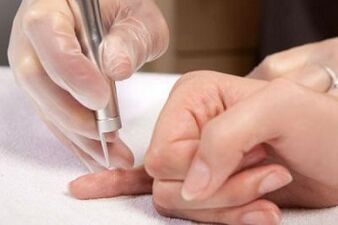 как да се отървете от папиломи по тялото