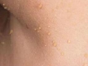 причини за появата на папиломи по тялото