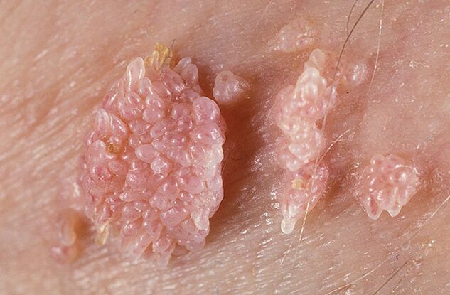 Папиломът е доброкачествено туморно образувание на кожата и лигавиците с брадавичен характер